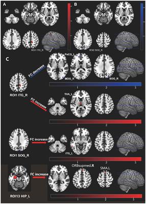 Brain function abnormalities and neuroinflammation in people living with HIV-associated anxiety disorders